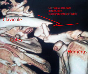 clavicule