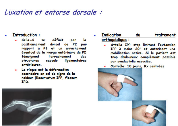 Fractures de la main, poignet et doigts